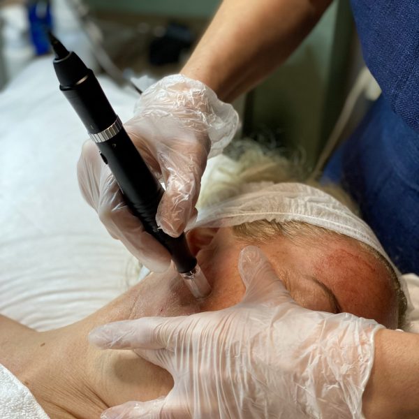 Microneedling